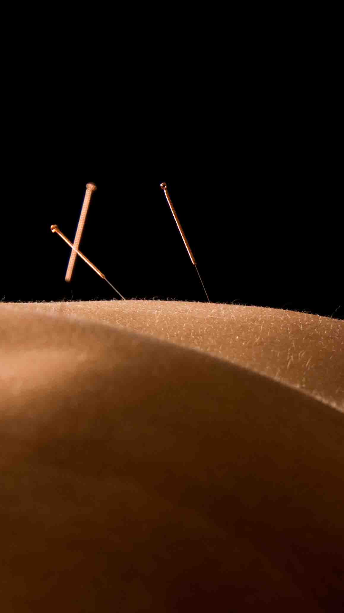 Dry Needling & Acupuncture